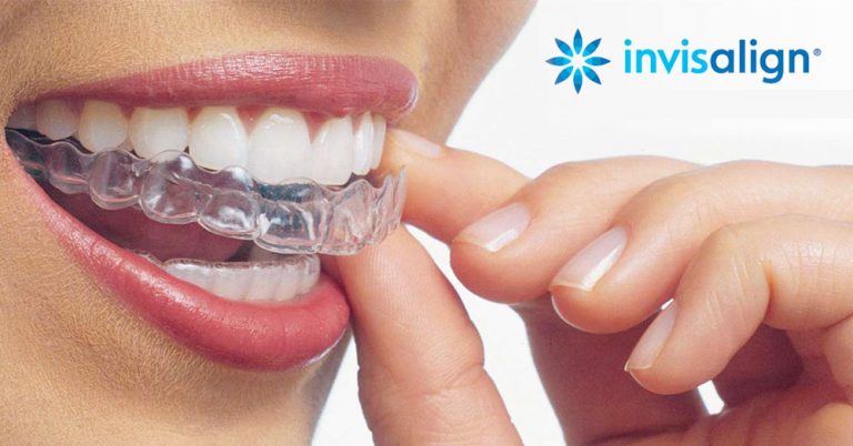 Invisalign ortodoncia invisible - Clínica Dental Sant Just
